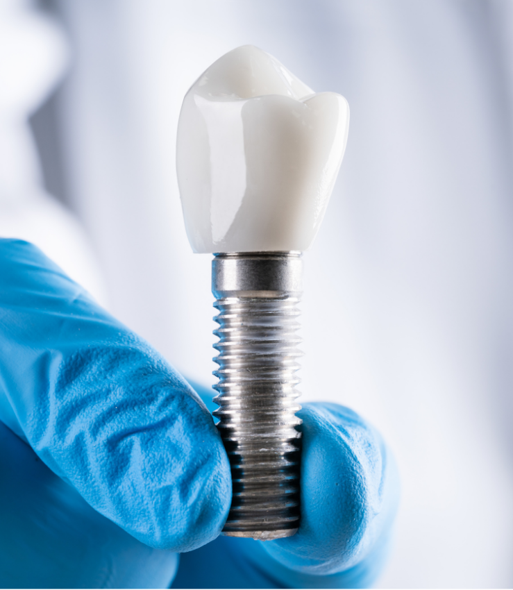 Single Tooth Dental Implants